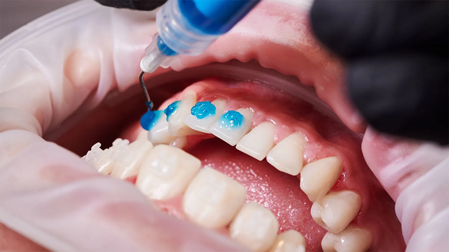 Tandblekning hos oss